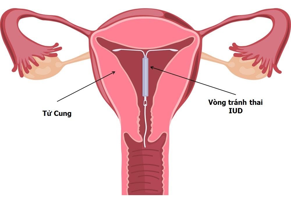 Đặt vòng tránh thai ở đâu uy tín, an toàn hiện nay