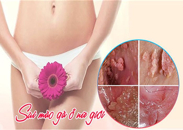 Những triệu chứng sùi mào gà ở nữ giới giai đoạn đầu