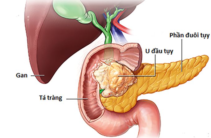 Tuyến tụy nằm ở đâu? Những bệnh lý liên quan đến tuyến tụy