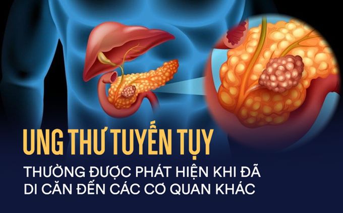 Tuyến tụy nằm ở đâu? Những bệnh lý liên quan đến tuyến tụy