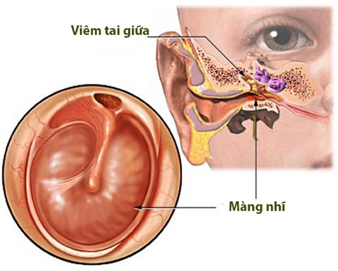 Màng nhĩ nằm ở đâu? Vì sao màng nhĩ bị thủng?