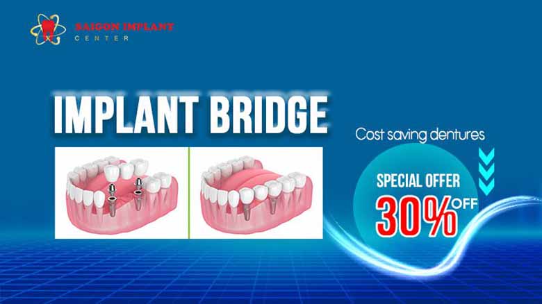 Dental Implant Bridges - A Comprehensive Guide from Saigon Implant Center