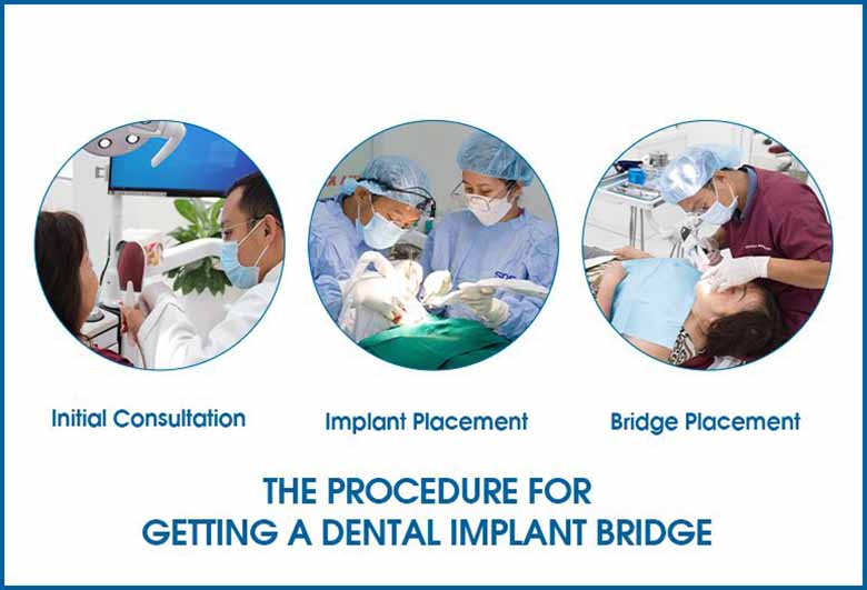 Dental Implant Bridges - A Comprehensive Guide from Saigon Implant Center